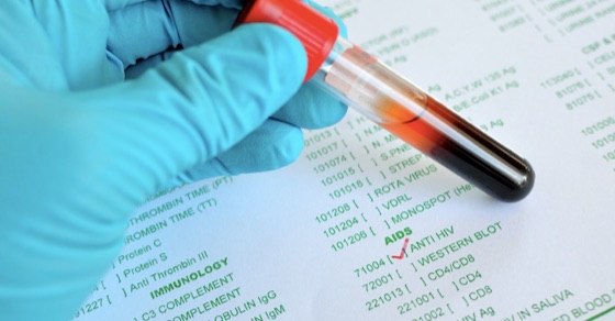 HIV、エイズ検査方法(検査キット、保健所)