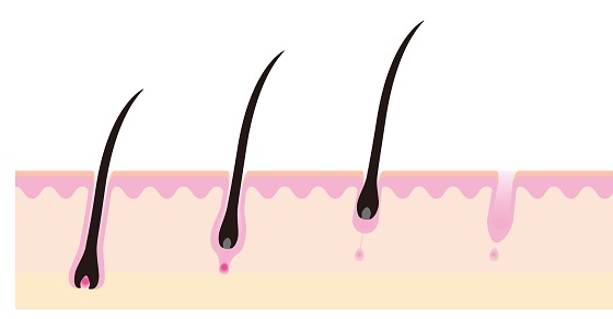 まだ脱毛は、絶対するな!今どきの脱毛方法が凄すぎた(コスパ最強)